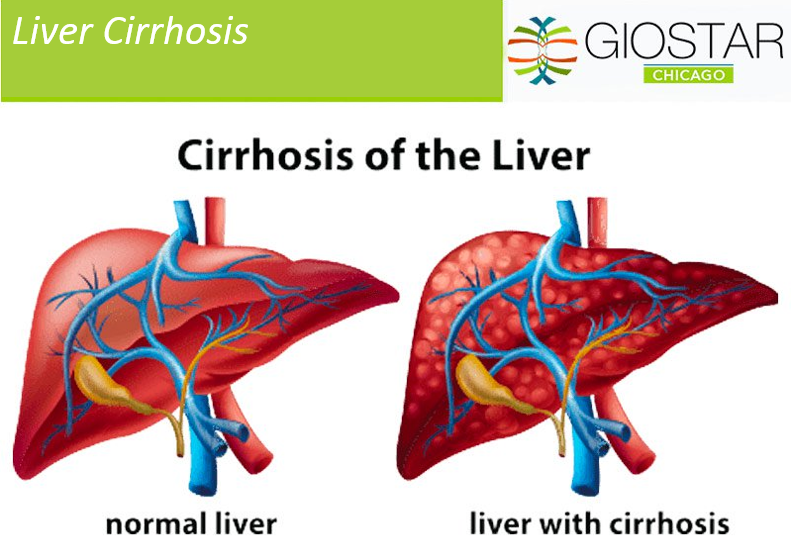 GIOSTAR Chicago: Liver Cirrhosis
